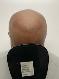 the back of a man's head after a hair transplant
