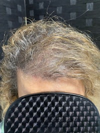 a woman's hair after a hair transplant