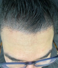 a man's hair before and after a hair transplant